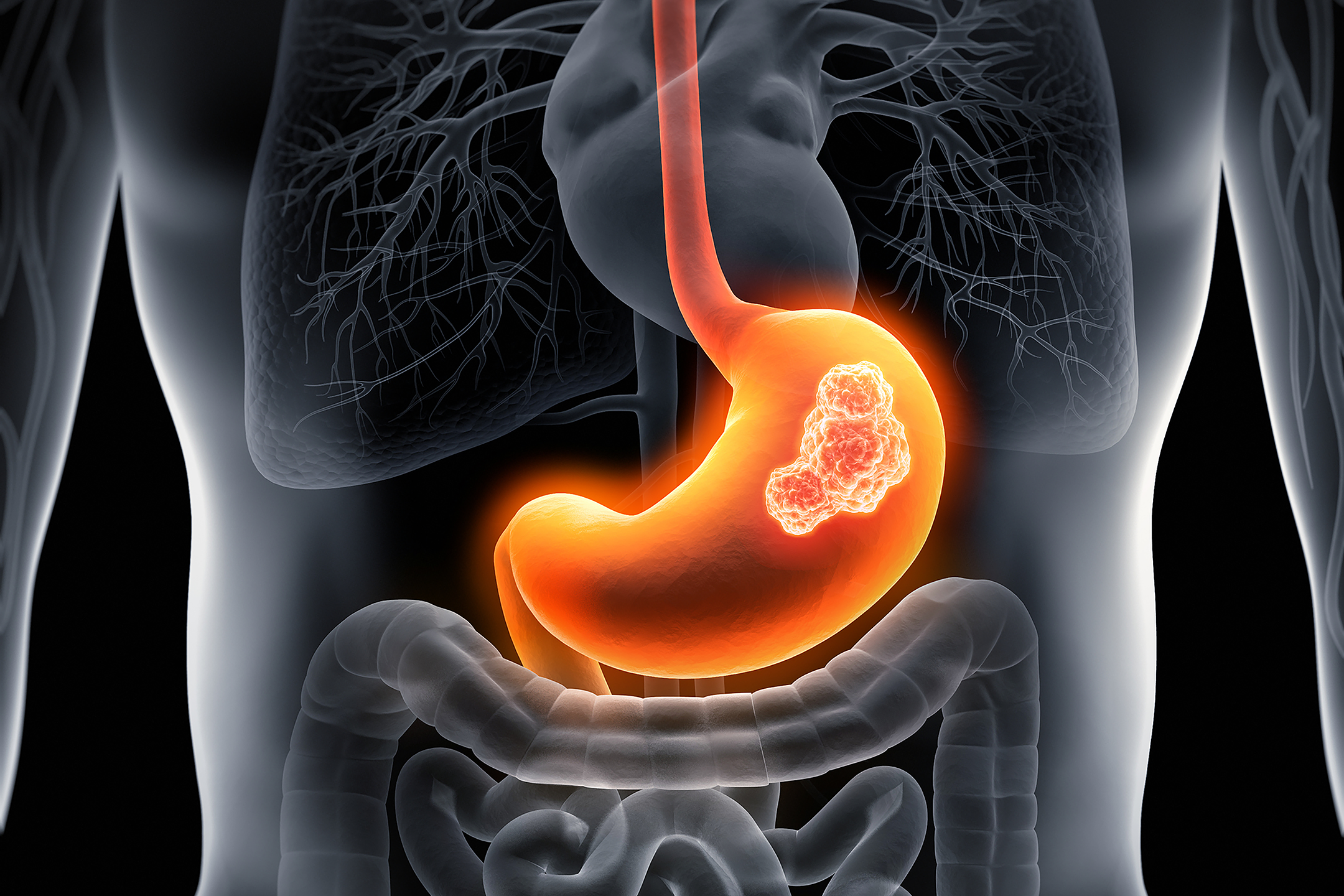 Single-cell analysis of metastatic gastric cancer finds diverse tumor cell populations associated with patient outcomes