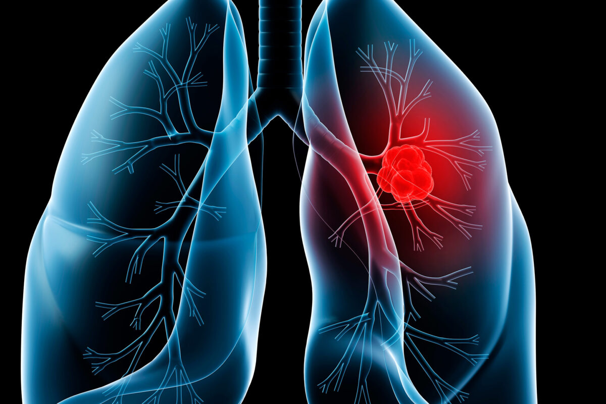 Daraxonrasib demonstrates initial antitumor activity in RAS-mutant lung cancer