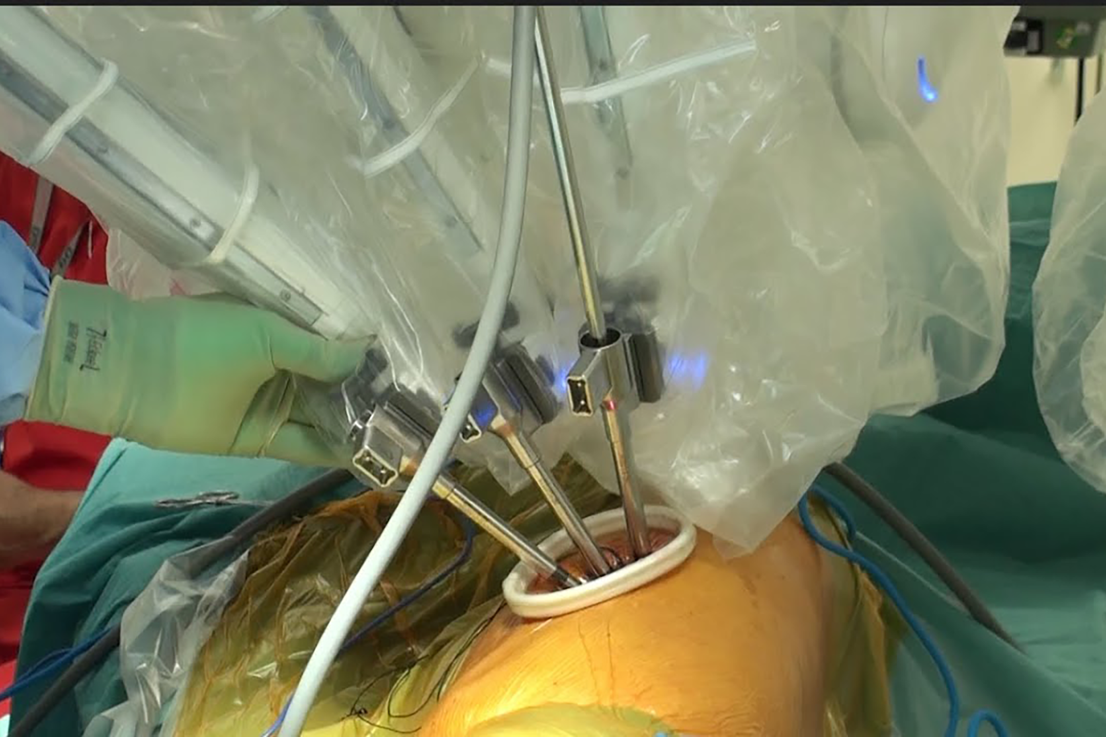 UTMB makes history with first uniportal robotic lobectomies in Texas