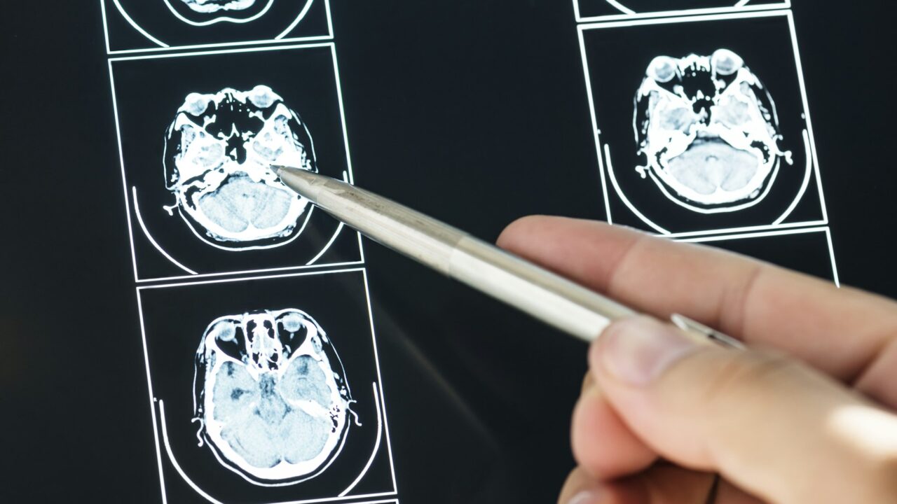 NK cells expressing interleukin-21 show promising antitumor activity in glioblastoma cells