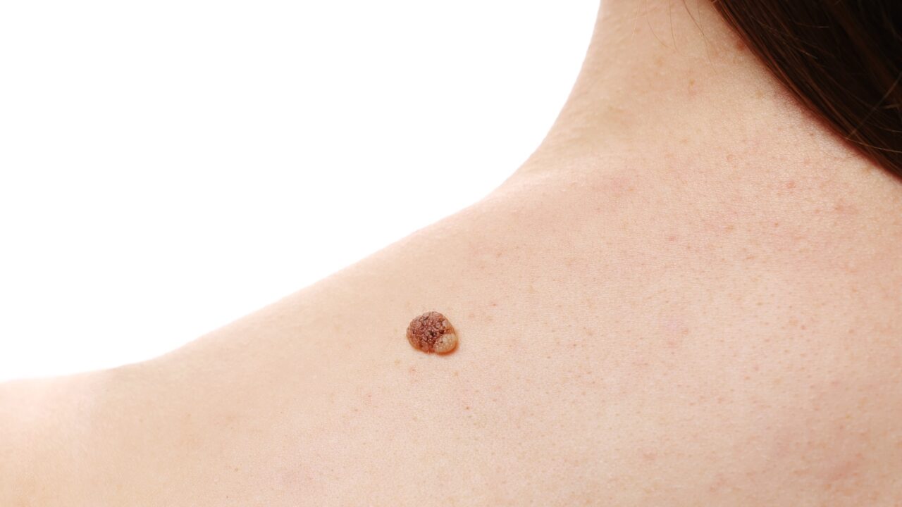 Vaccine-based combination therapy improves antitumor immune responses in melanoma