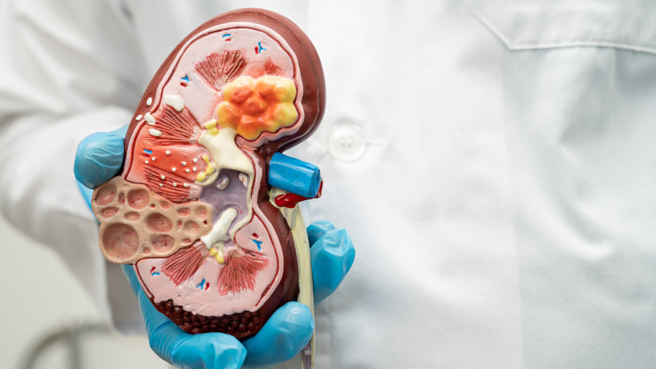 Researchers identify potential markers of exceptional immunotherapy responses in renal cell carcinoma