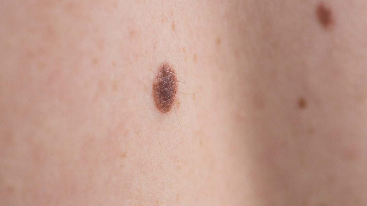 Most patients with advanced melanoma who received pre-surgical immunotherapy remain alive and disease free four years later