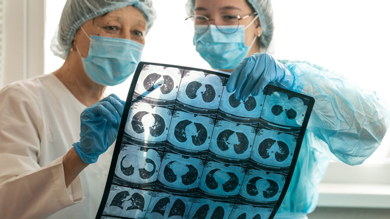 Novel drug confirms NSD2 protein as therapeutic target in lung and pancreatic cancers