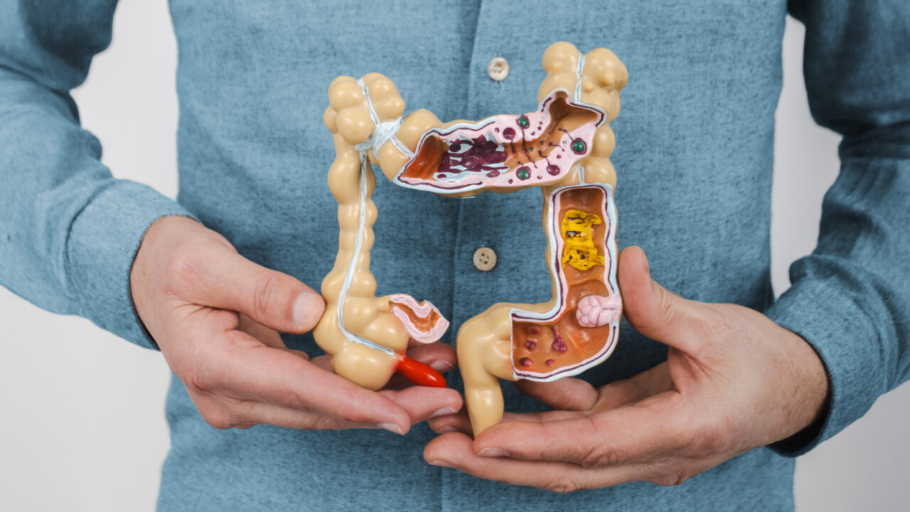 Triple combination therapy shows promise for treatment-resistant microsatellite stable BRAF V600E-mutant metastatic colorectal cancer