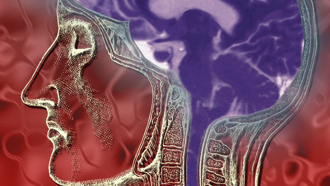 Traces of bacteria inside brain tumors may affect tumor behavior