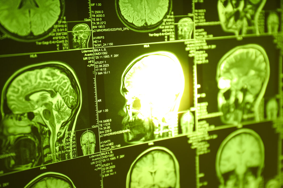 Blood biomarker points to increased risk of brain metastasis in patients with inflammatory breast cancer