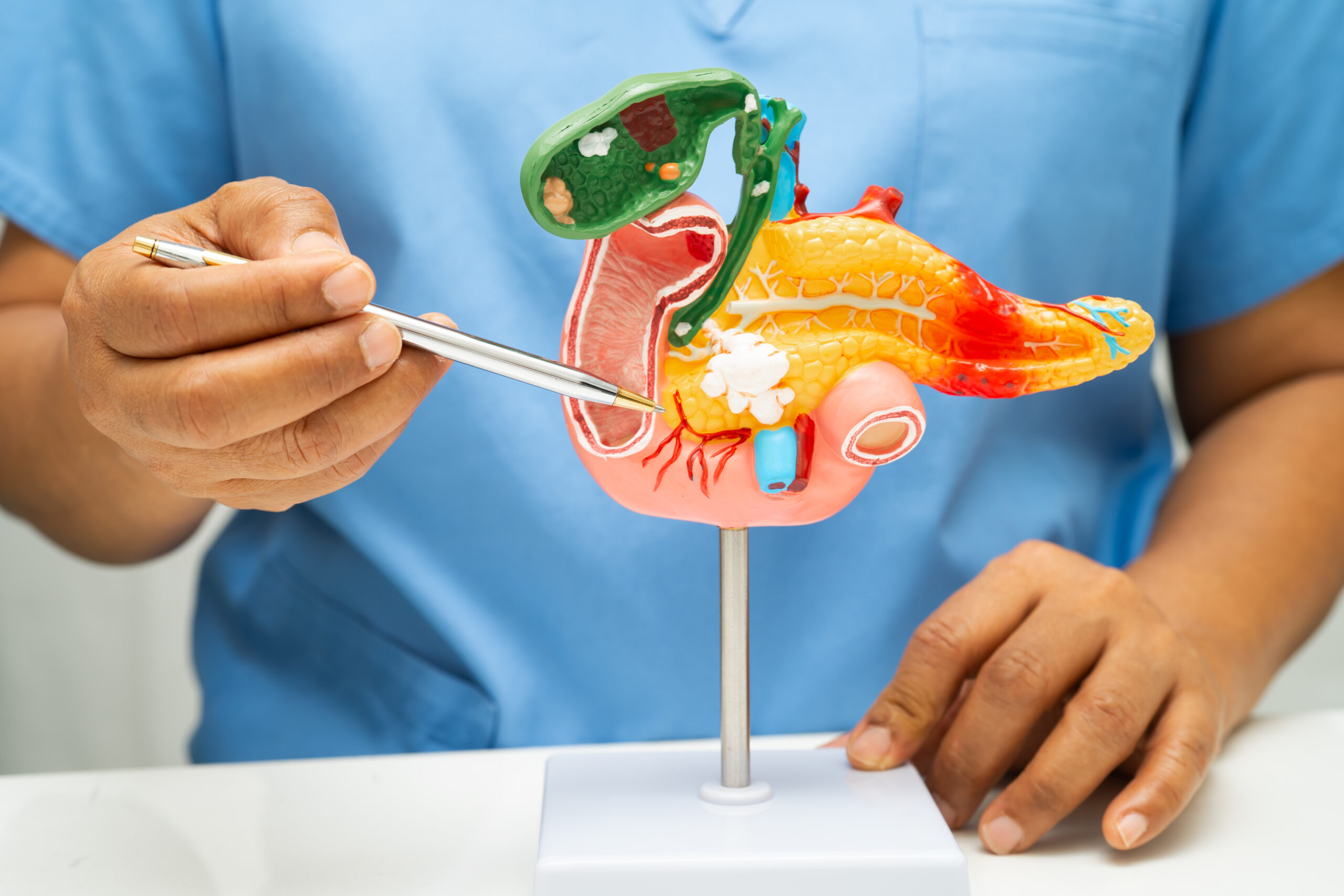 RAS inhibitor daraxonrasib demonstrates initial anti-tumor activity in pancreatic cancer