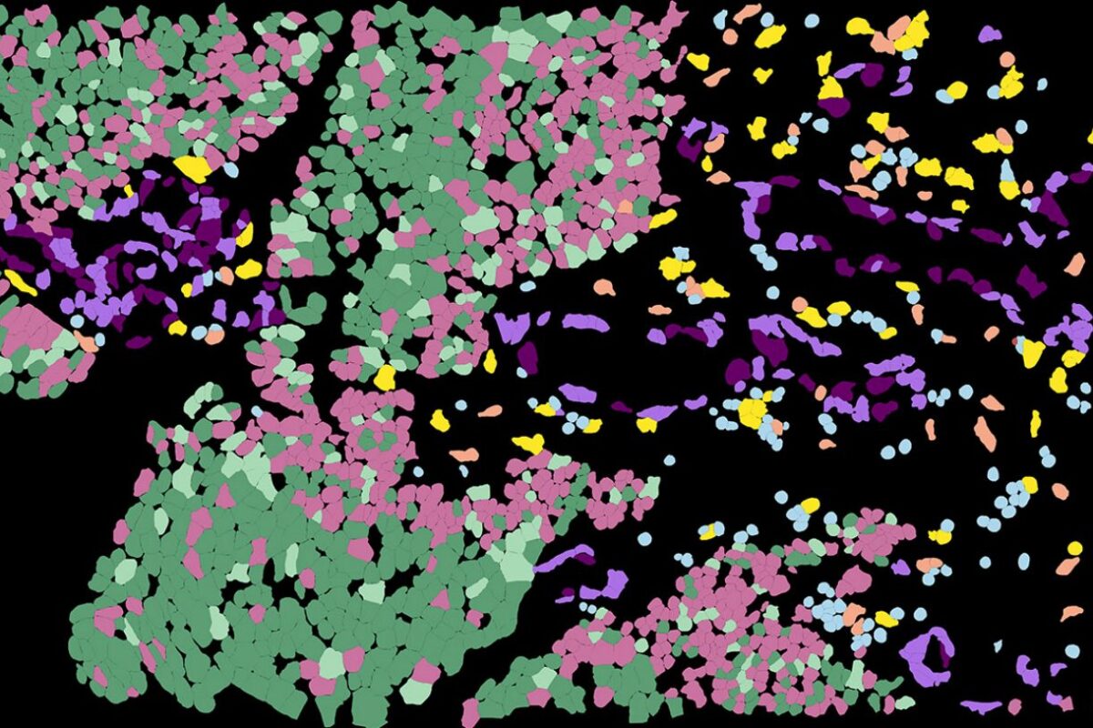 Spatial map of bladder cancer reveals hidden tumor environments and new paths toward precision therapy